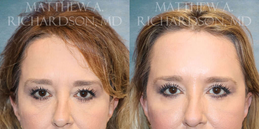 Eyes Close UpUpper Bleph by Dr Richardson