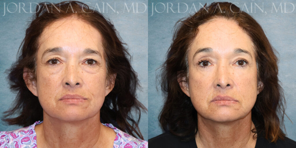Frontal Brow Lift Fat Grafting Lower Blepharoplasty by Dr Cain