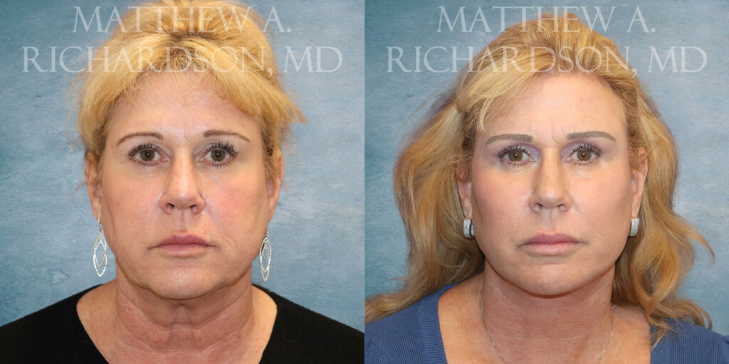 Frontal CO Laser Facelift Fat Grafting by Dr Richardson