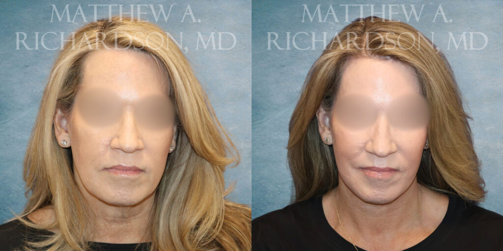 Frontal CO Laser Facelift by Dr Richardson