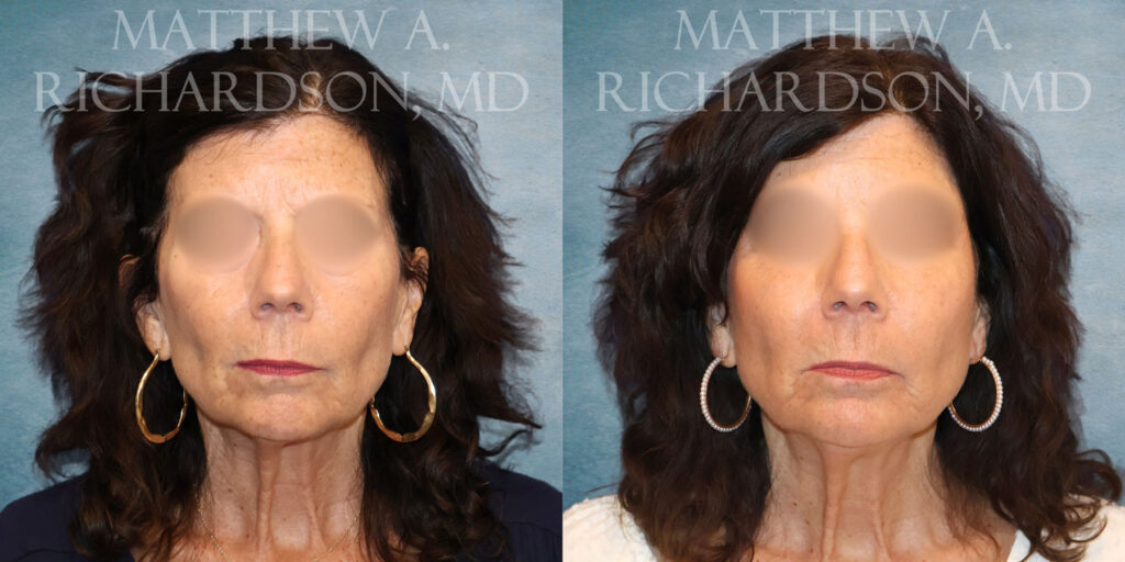 Frontal CO Laser Fat Grafting by Dr Richardson