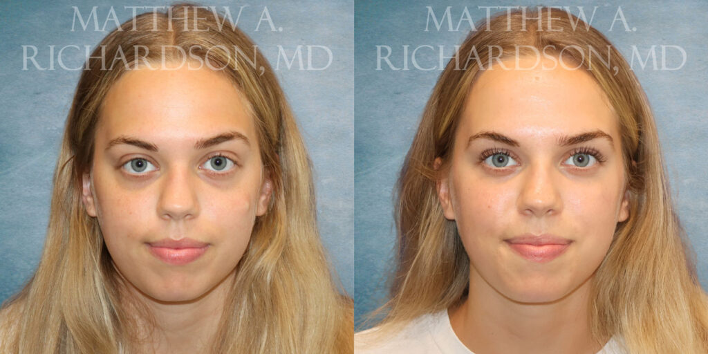 Frontal Cyst Removal by Dr Richardson