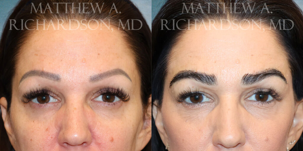 Frontal Eyebrow Transplant by Dr Richardson