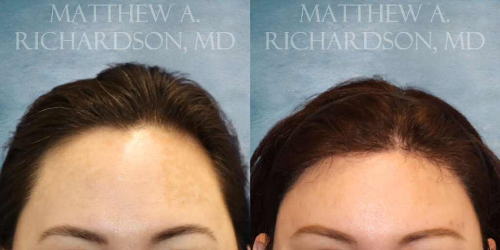 Frontal Forehead Reduction FUT Hair Transplant by Dr Richardson