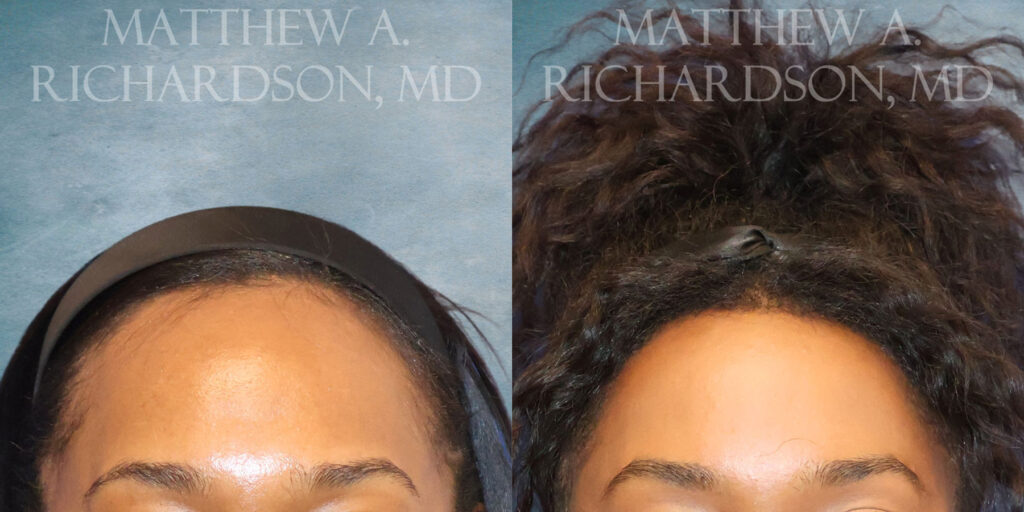 Frontal Forehead Reduction by Dr Richardson