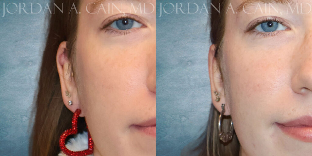 Frontal Keloid Removal by Dr Cain