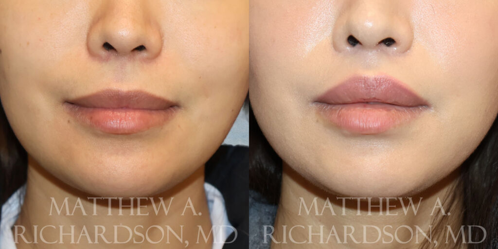 Frontal Lip Lift by Dr Richardson