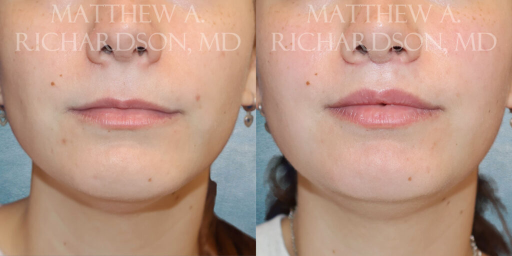 Frontal Lip Lift by Dr Richardson