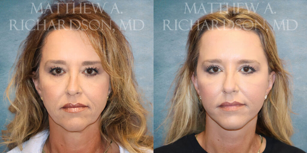 Frontal Upper Bleph CO Laser Facelift by Dr Richardson