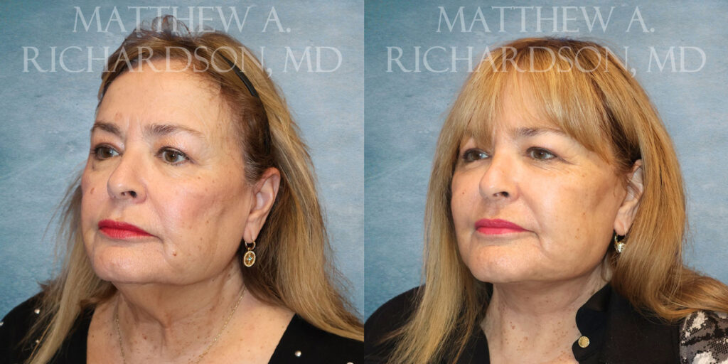 Left Oblique CO Laser Facelift by Dr Richardson