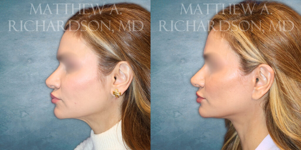 Left Profile Mini Lift by Dr Richardson