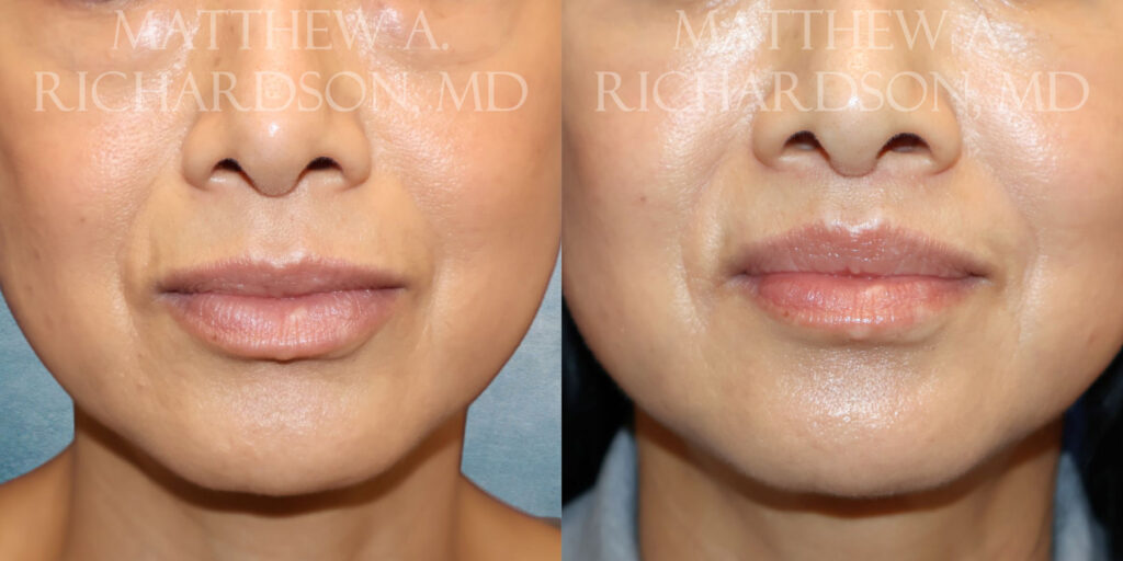 Lips CLose Up Lip Lift by Dr Richardson