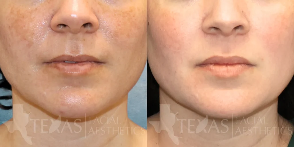 Frontal Close Up View Nano Laser Peels before and after photo by Renaida