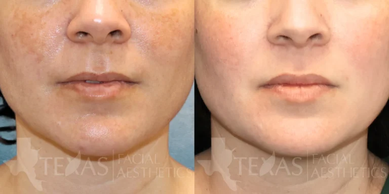 Frontal Close Up View Nano Laser Peels before and after photo by Renaida Frontal Close Up View Nano Laser Peels before and after photo by Renaida