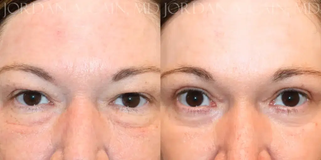 Frontal Close Up View Upper Blepharoplasty before and after photo by Dr. Cain