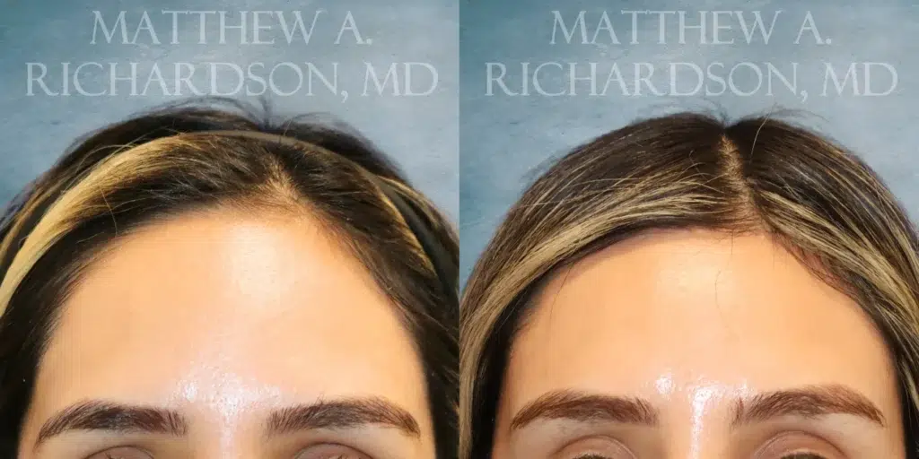 Frontal View Forehead Reduction before and after photo by Dr. Richardson