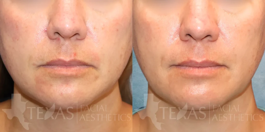 Frontal View Forever Clear BBL before and after photo by Renaida