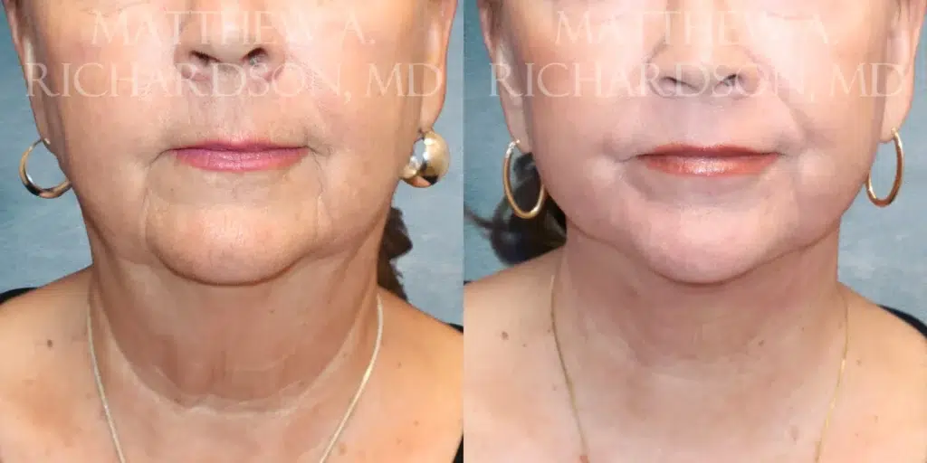 Frontal View Lower Facelift before and after photo by Dr. Richardson