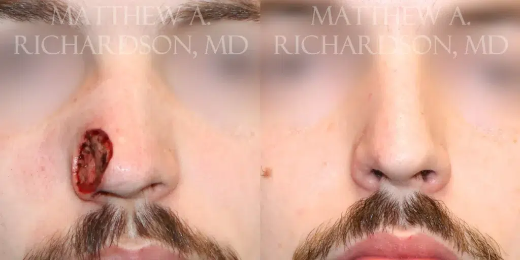 Frontal View MOHS before and after photo by Dr. Richardson