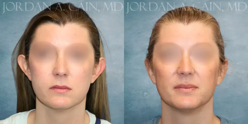 Frontal View Otoplasty before and after photo by Dr. Cain