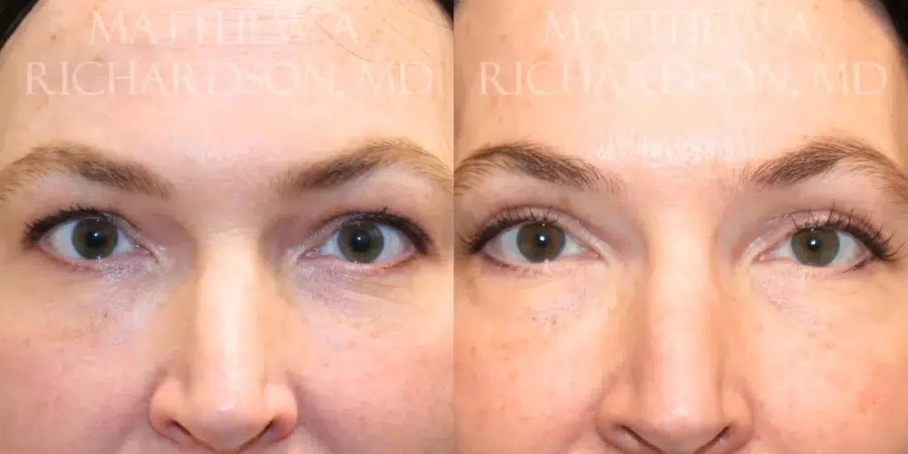 Frontal View Upper Blepharoplasty before and after photo by Dr. Richardson