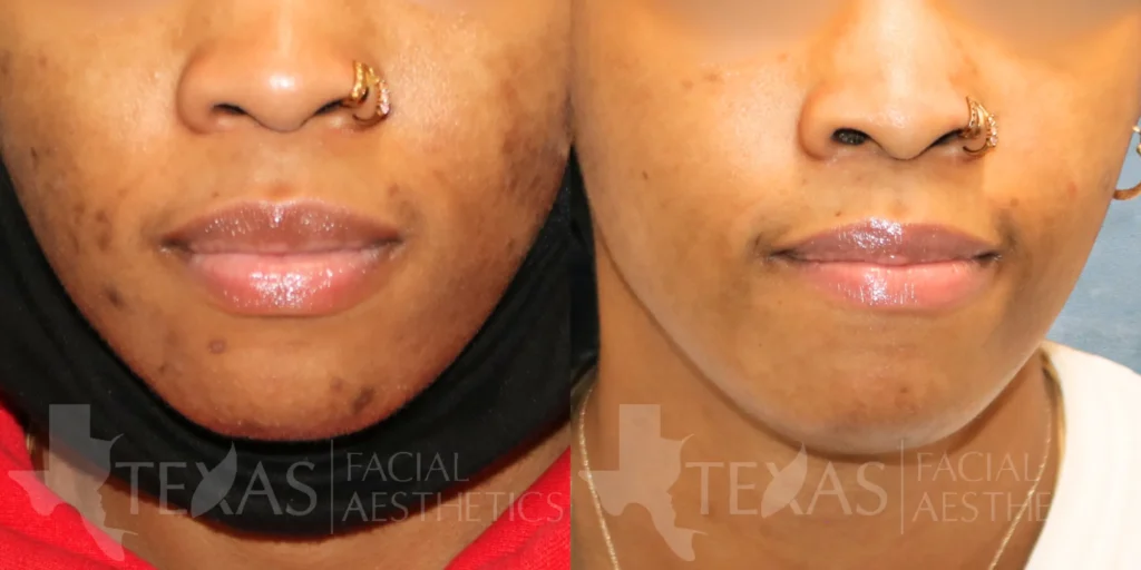 Frontal View Vi Peel before and after photo by Renaida