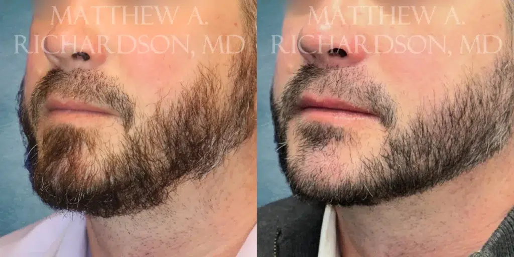 Left Oblique View Beard Transplant before and after photo by Dr. Richardson