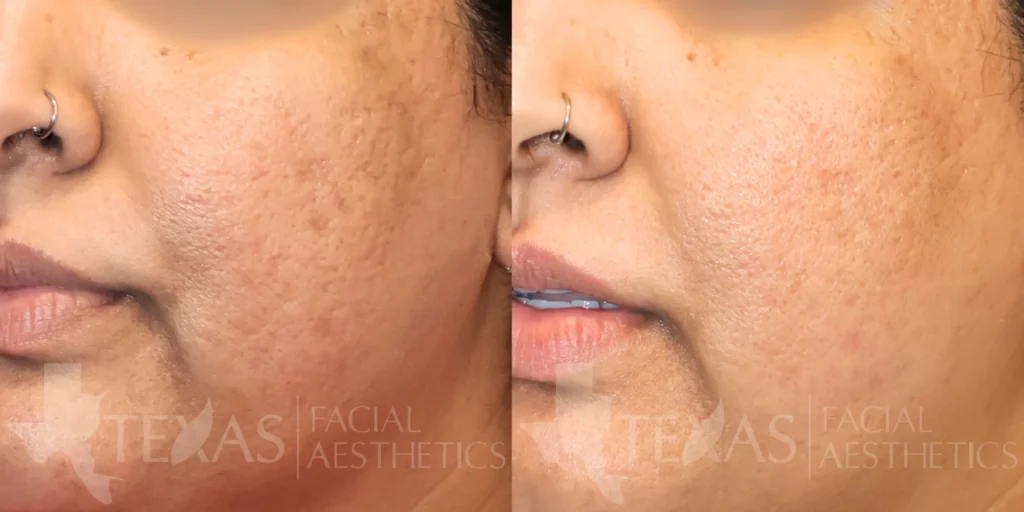 Left Oblique View Halo Treatment before and after photo by Bria