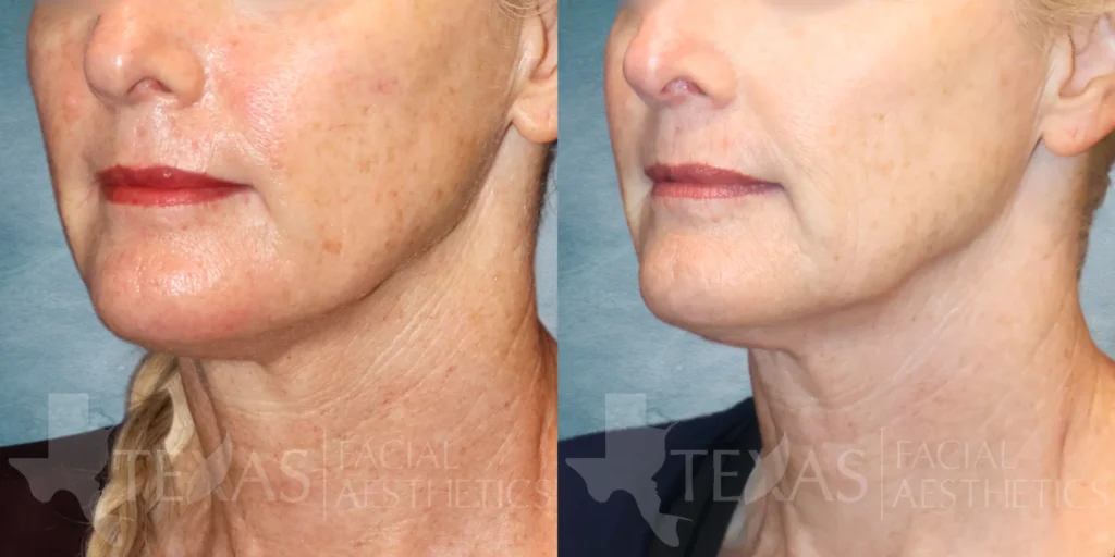 Left Oblique View Microneedling before and after photo by Renaida