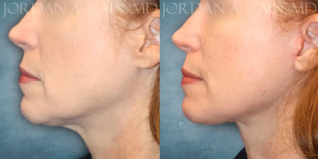 Left Profile View Lower Facelift before and after photo by Dr. Cain