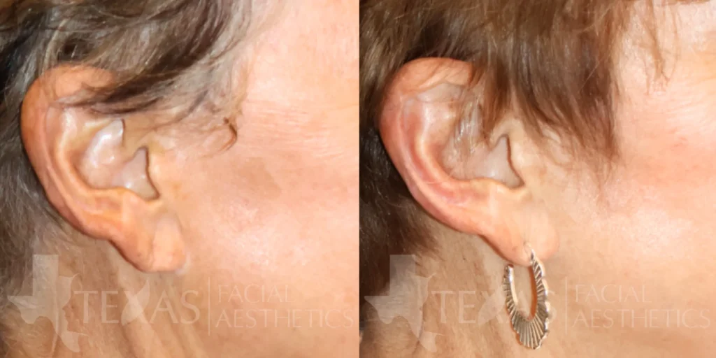 Right Side View Nano Laser Peel before and after photo by Bria