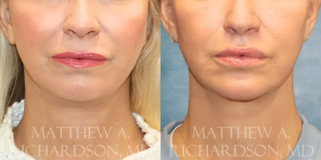 Front View Lip Lift before and after photo by Dr. Richardson