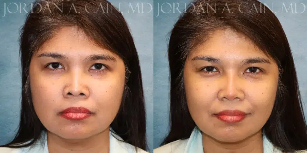 Front View Non Surgical Rhinoplasty before and after photo by Dr. Cain