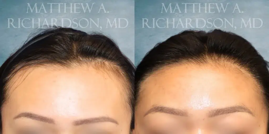 Frontal View Hair Transplant before and after photo by Dr. Richardson