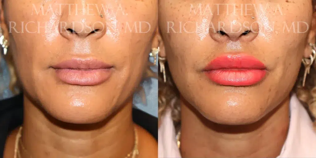 Frontal View Lip Lift before and after photo by Dr. Richardson