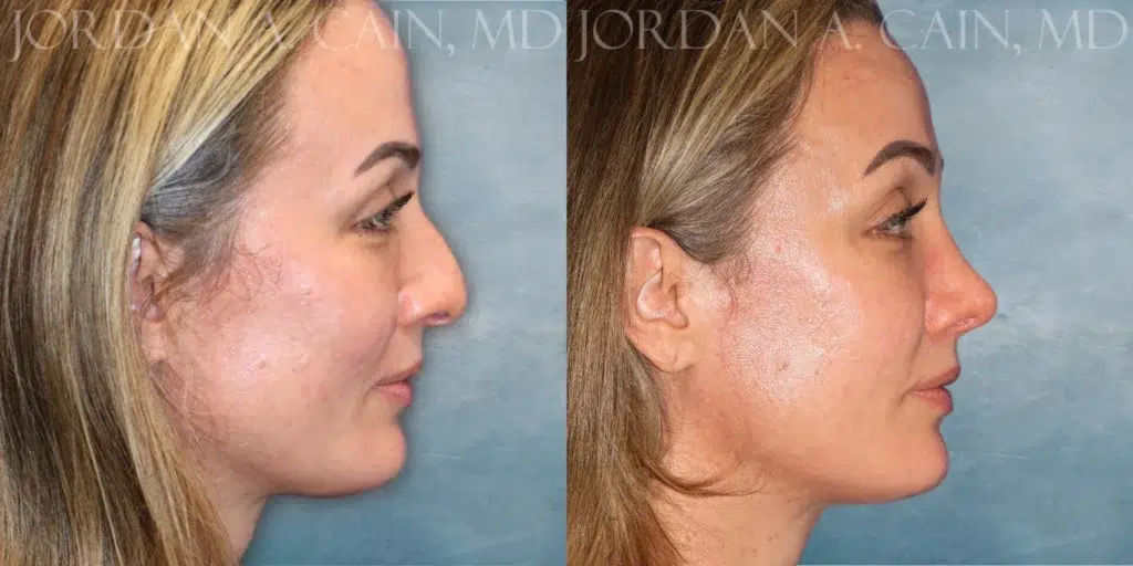 Right Side View Rhinoplasty before and after photo by Dr. Cain