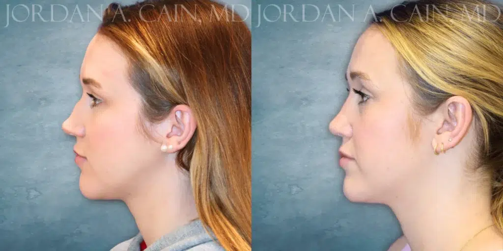 Right Side View Rhinoplasty before and after photo by Dr. Cain