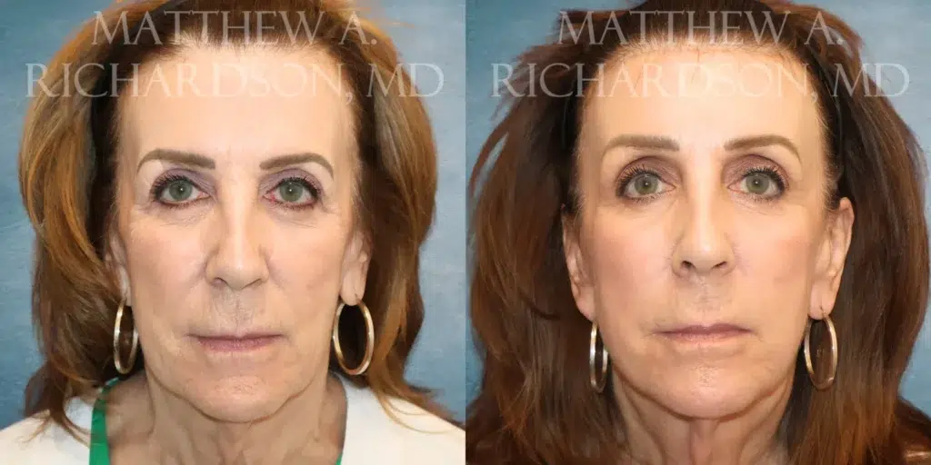 Frontal View Brow lift, TRL before and after photo by Dr. Richardson