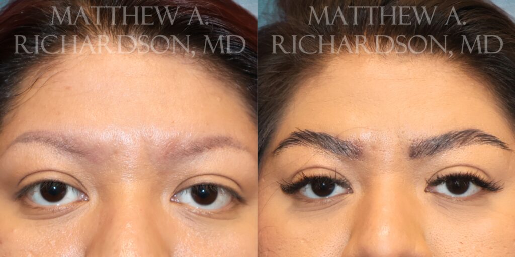 Frontal View FUT Eyebrow Transplant before and after photo by Dr. Richardson