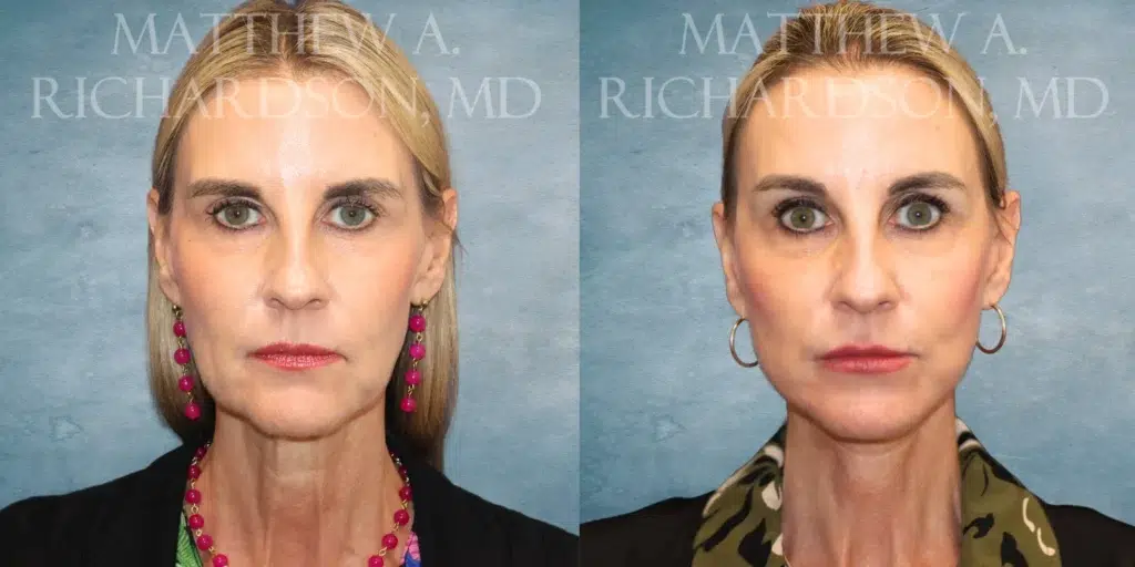 Frontal View Facelift, Brow lift before and after photo by Dr. Richardson