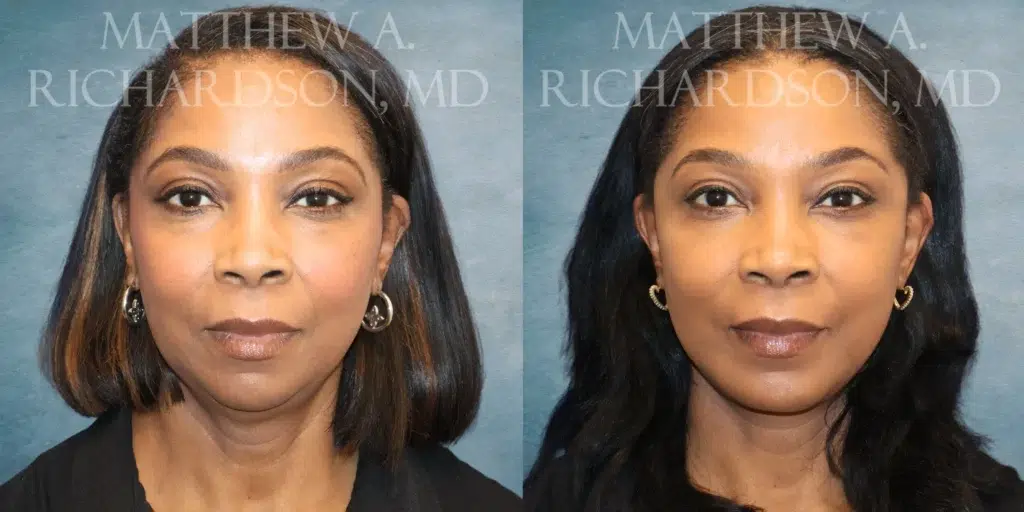 Frontal View Facelift, Chin Implant before and after photo by Dr. Richardson