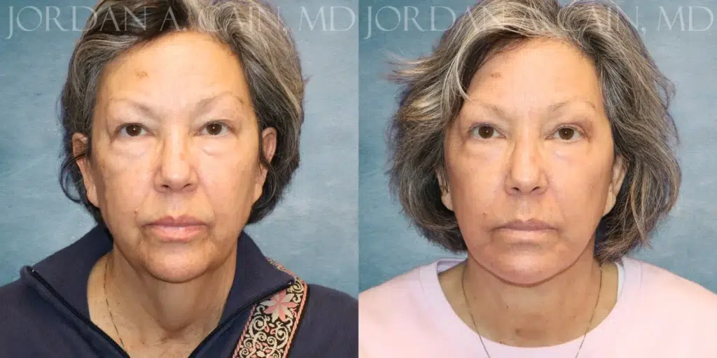 Frontal View Facelift and CO Laser before and after photo by Dr. Cain