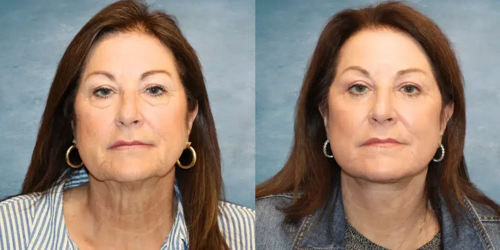 Frontal View Facelift, lower bleph, TRL before and after photo by Dr. Richardson