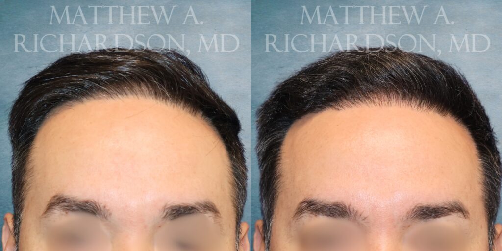 Frontal View Fue Hair transplant before and after photo by Dr. Richardson