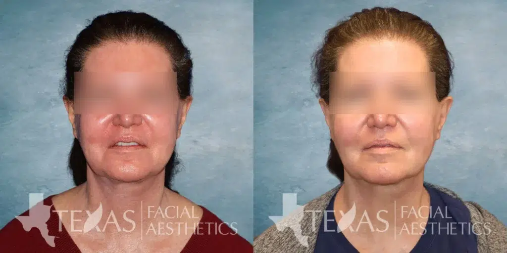Frontal View BBL and Chemical Peels before and after photo by Aesthetician