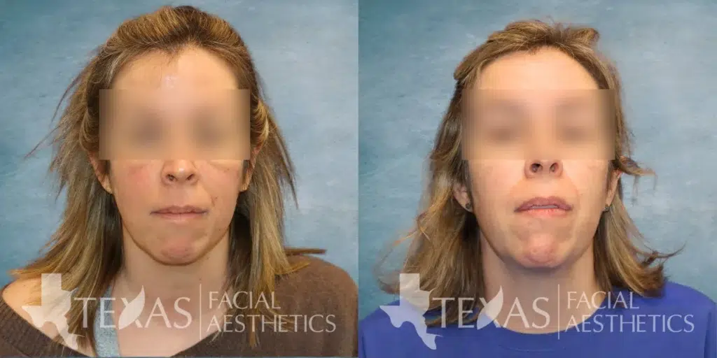 Frontal View BBL before and after photo by Aesthetician