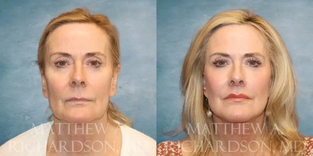 Frontal View Facelift, Lip Lift and Fat Grafting before and after photo by Dr. Richardson
