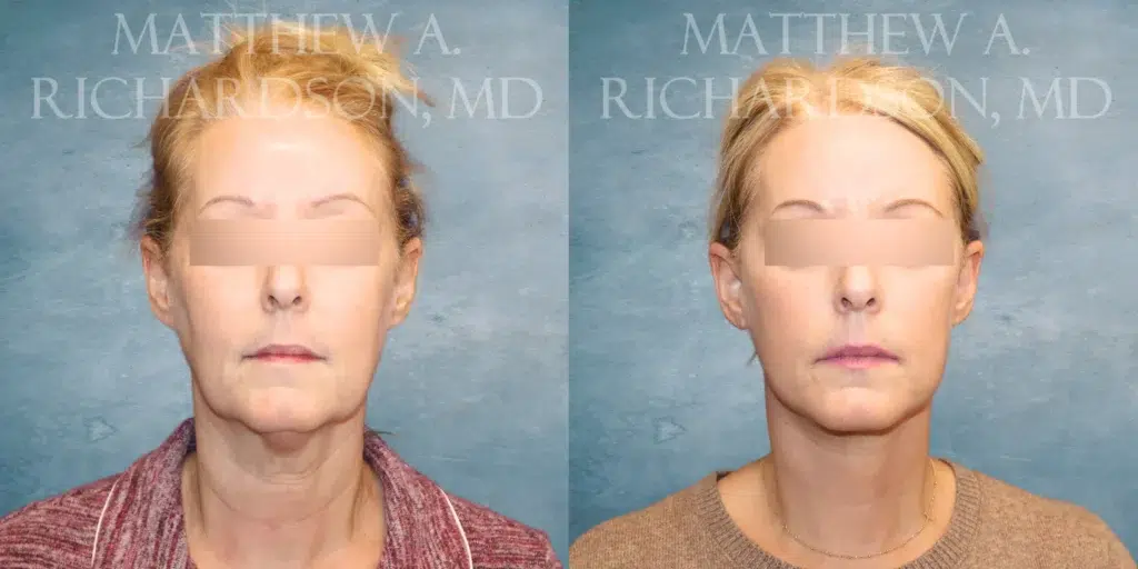 Frontal View Lower Face and Neck Lift before and after photo by Dr. Richardson